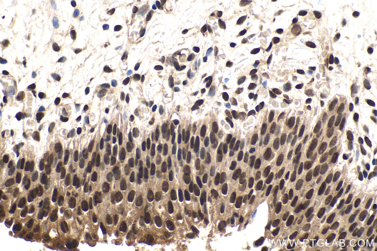 Immunohistochemical analysis of paraffin-embedded human urothelial carcinoma tissue slide using KHC1578 (TIA1 IHC Kit).