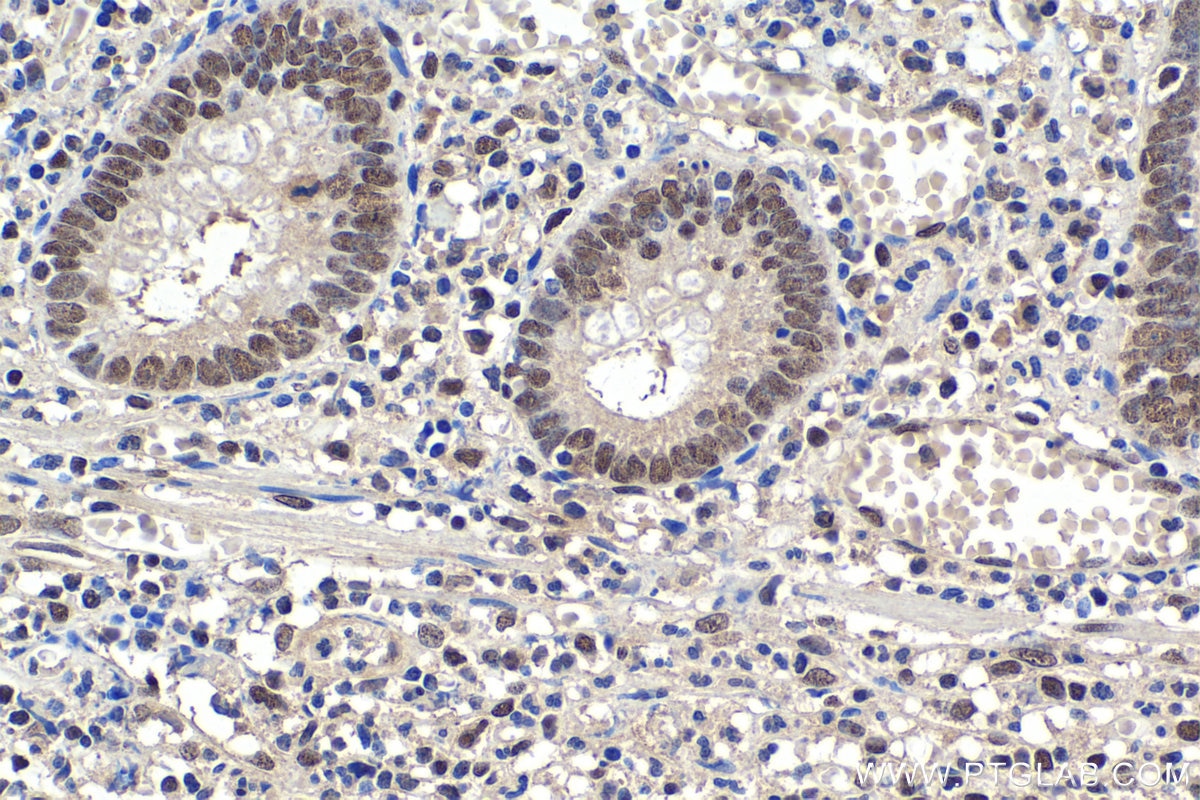 Immunohistochemical analysis of paraffin-embedded human appendicitis tissue slide using KHC1662 (TIAL1 IHC Kit).