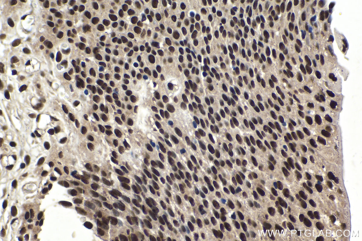 Immunohistochemical analysis of paraffin-embedded human urothelial carcinoma tissue slide using KHC1662 (TIAL1 IHC Kit).