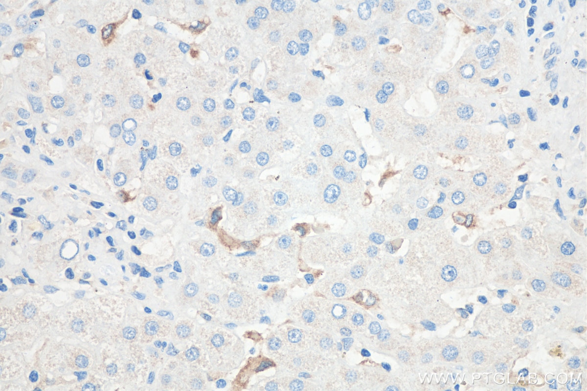 Immunohistochemical analysis of paraffin-embedded human liver cancer tissue slide using KHC0495 (TIMD4 IHC Kit).