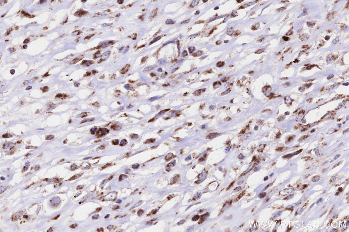Immunohistochemical analysis of paraffin-embedded human colon cancer tissue slide using KHC3238 (TIMM10 IHC Kit).