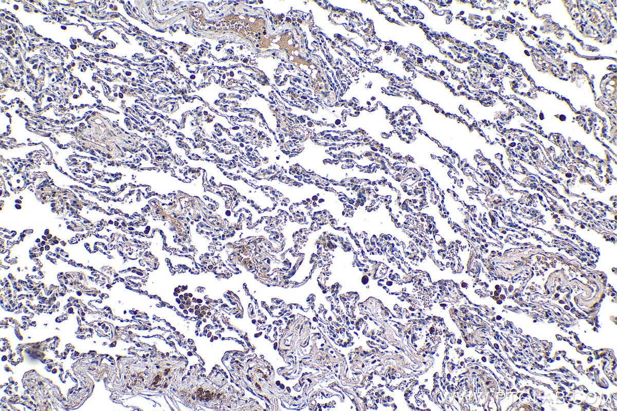 Immunohistochemical analysis of paraffin-embedded human lung cancer tissue slide using KHC1185 (TIMM17A IHC Kit).