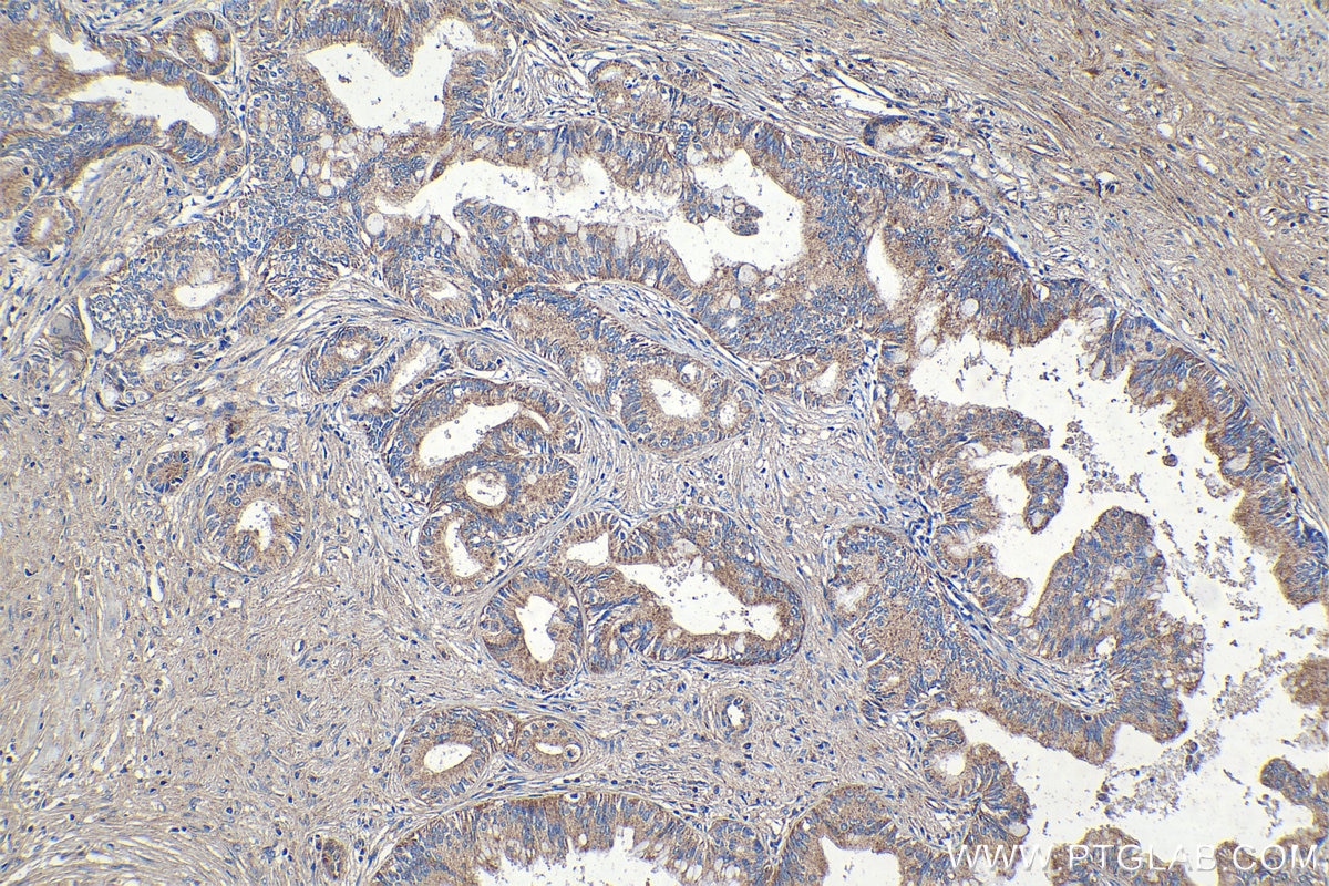 Immunohistochemical analysis of paraffin-embedded human pancreas cancer tissue slide using KHC1185 (TIMM17A IHC Kit).