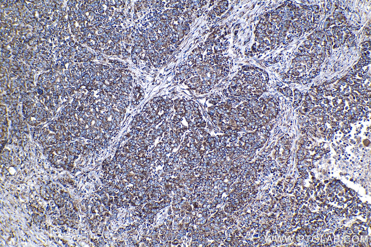 Immunohistochemical analysis of paraffin-embedded human ovary tumor tissue slide using KHC1304 (TIMM9 IHC Kit).