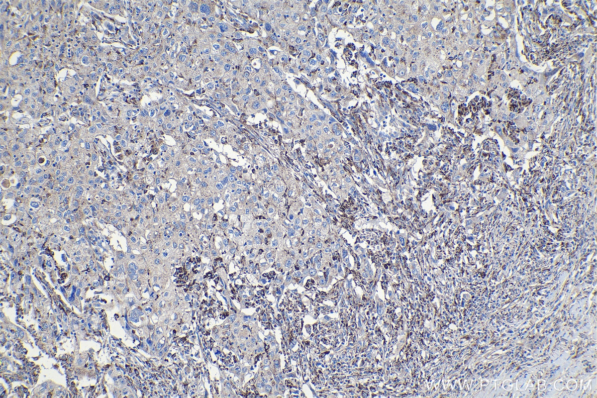Immunohistochemical analysis of paraffin-embedded human lung cancer tissue slide using KHC1154 (TIMP2 IHC Kit).