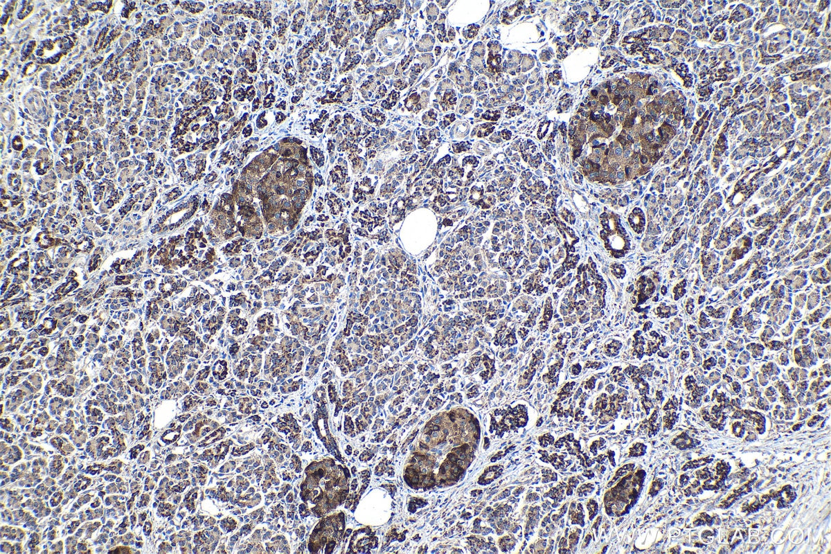 Immunohistochemical analysis of paraffin-embedded human pancreas cancer tissue slide using KHC1154 (TIMP2 IHC Kit).