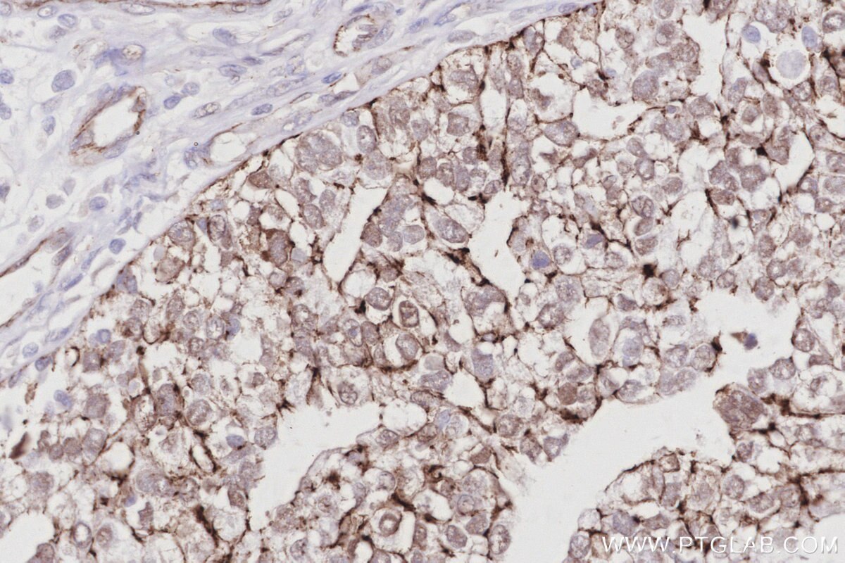 Immunohistochemical analysis of paraffin-embedded human ovary cancer tissue slide using KHC3003 (TJP2/ZO-2 IHC Kit).