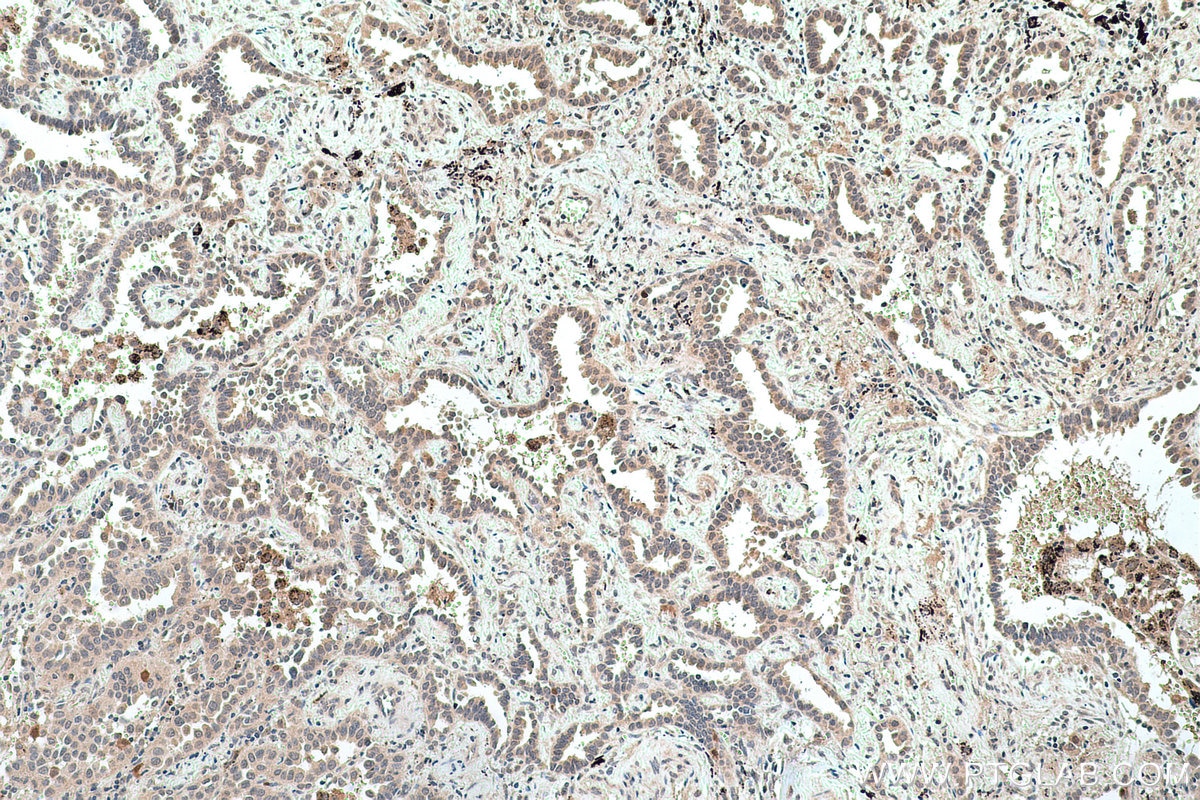 Immunohistochemical analysis of paraffin-embedded human lung cancer tissue slide using KHC0765 (TK1 IHC Kit).