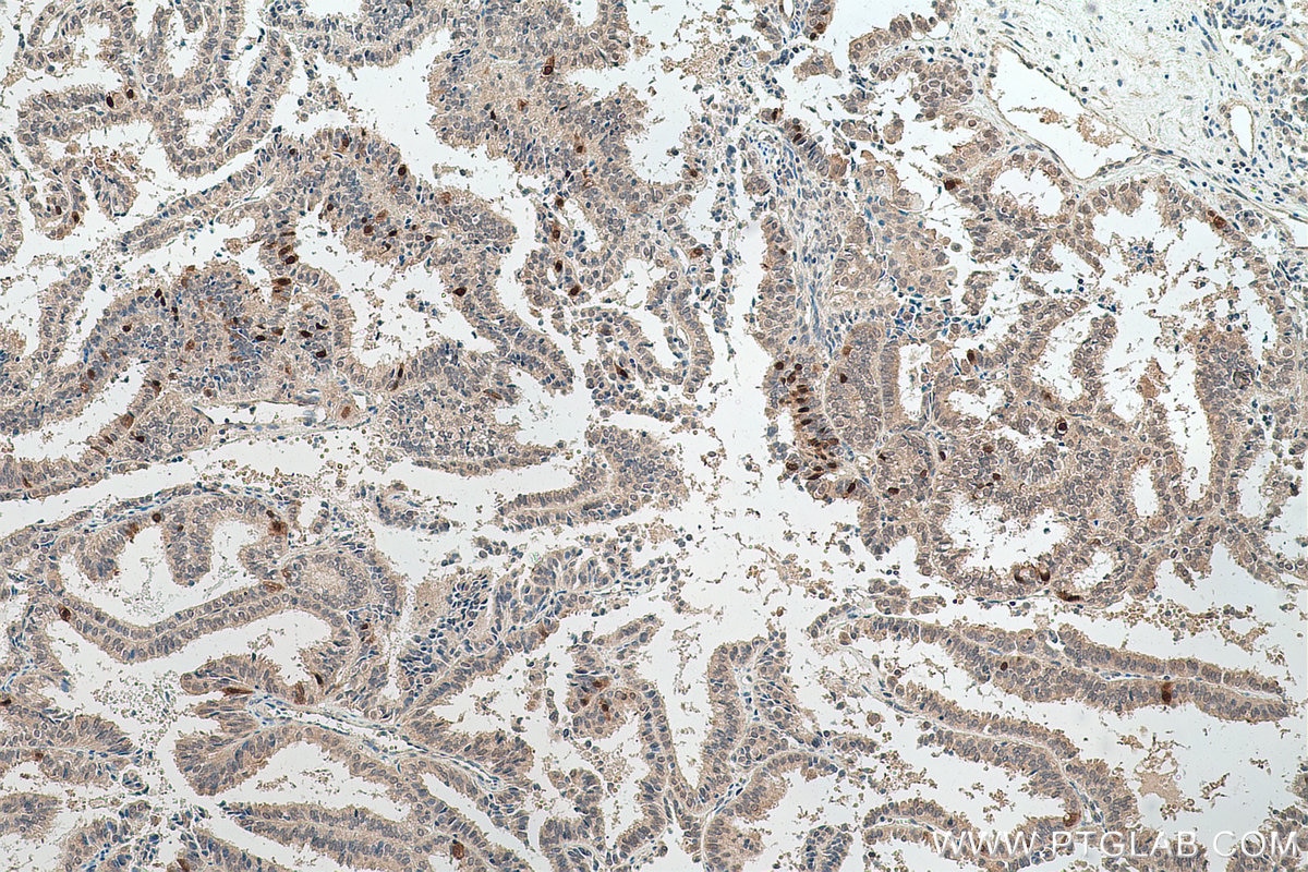 Immunohistochemical analysis of paraffin-embedded human ovary tumor tissue slide using KHC0765 (TK1 IHC Kit).