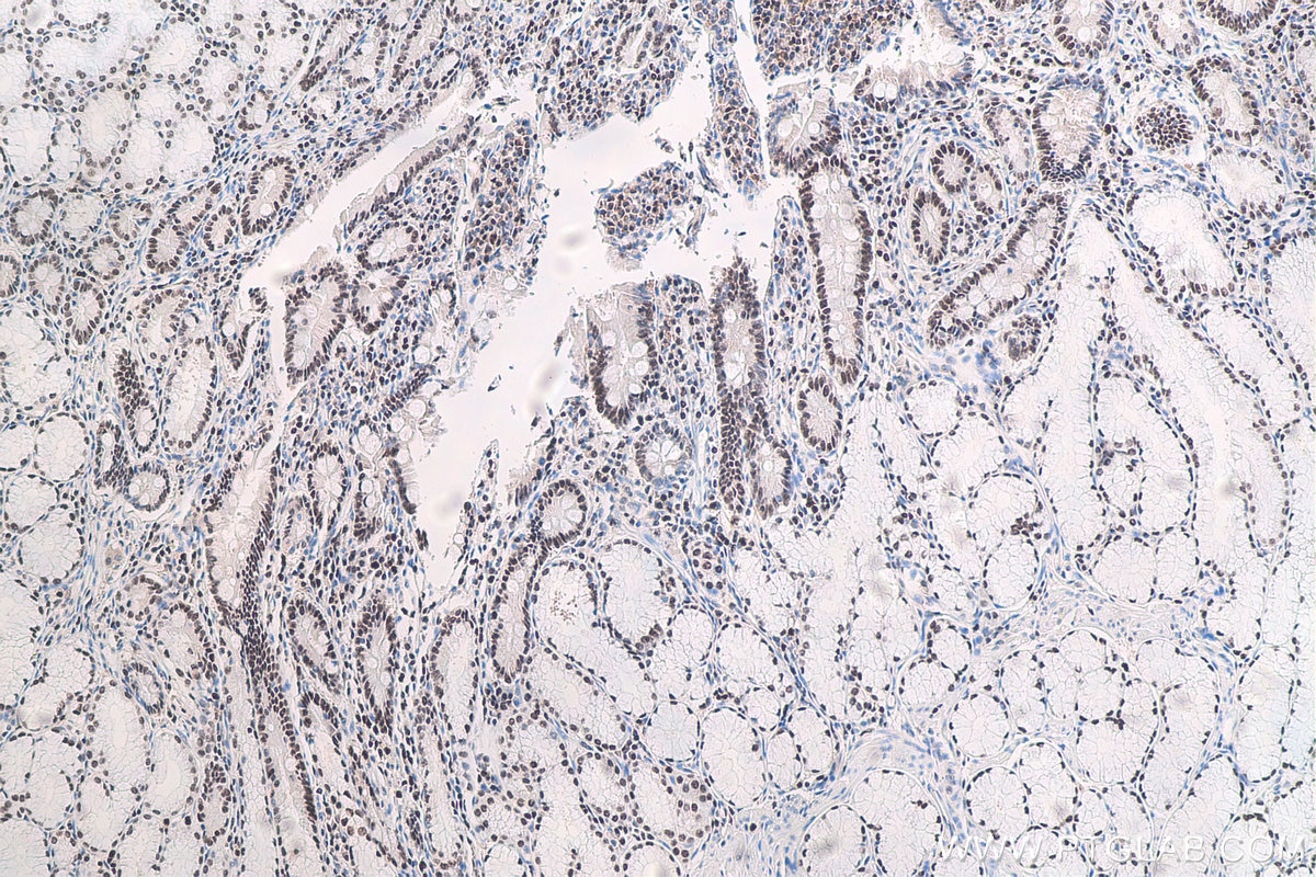 Immunohistochemical analysis of paraffin-embedded human stomach cancer tissue slide using KHC0672 (TKT IHC Kit).