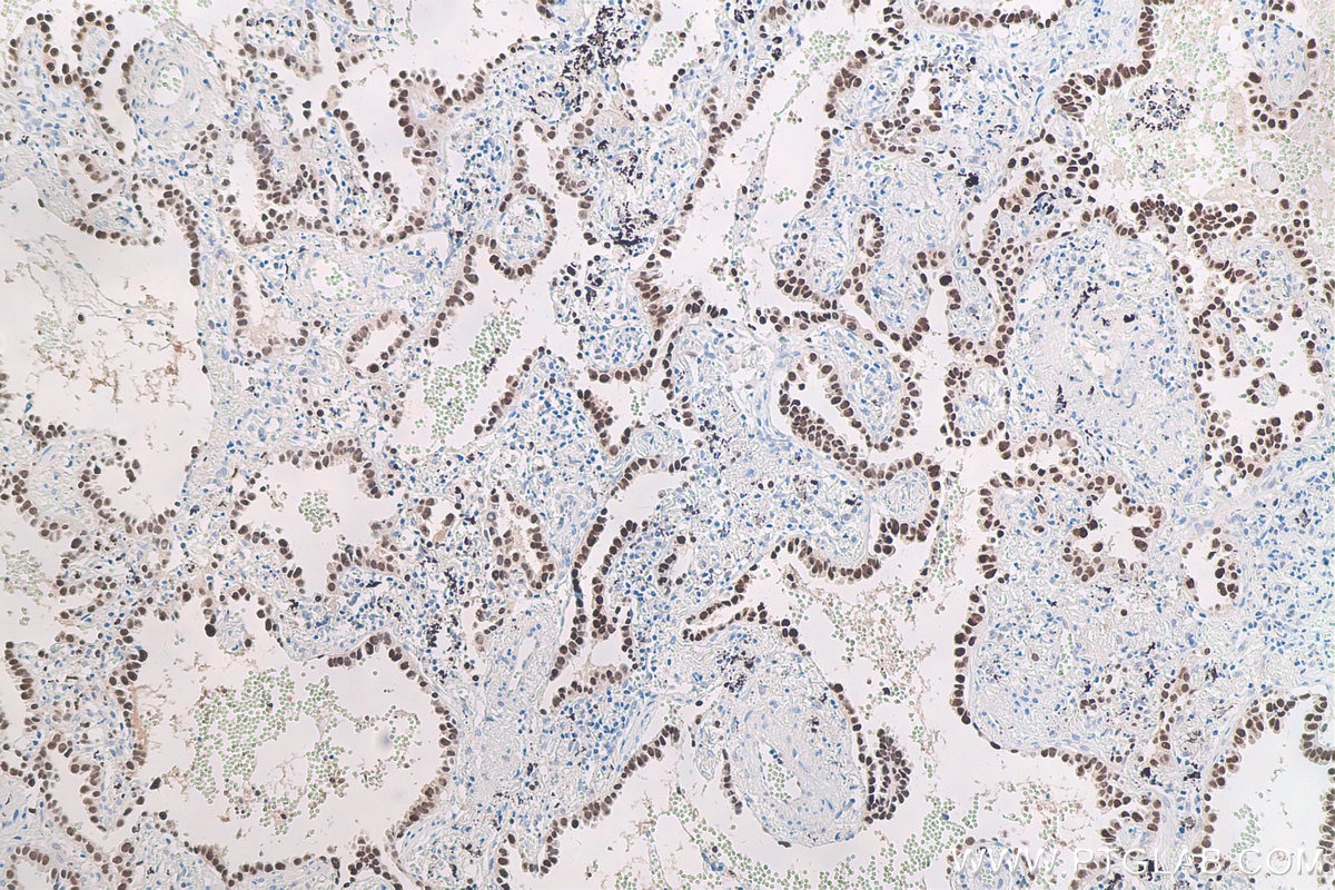 Immunohistochemical analysis of paraffin-embedded human lung cancer tissue slide using KHC0672 (TKT IHC Kit).