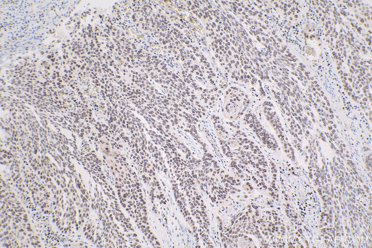 Immunohistochemical analysis of paraffin-embedded human oesophagus cancer tissue slide using KHC1673 (TLE3 IHC Kit).
