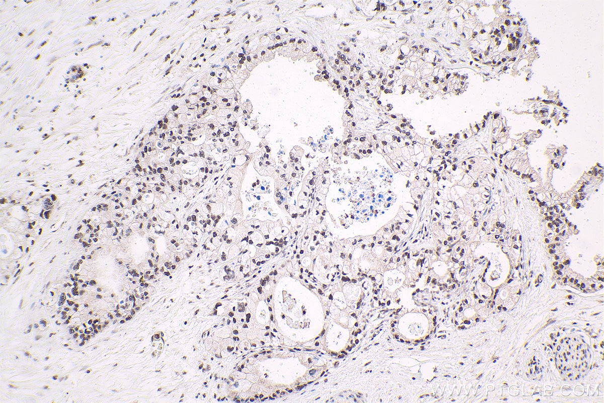 Immunohistochemical analysis of paraffin-embedded human pancreas cancer tissue slide using KHC1673 (TLE3 IHC Kit).