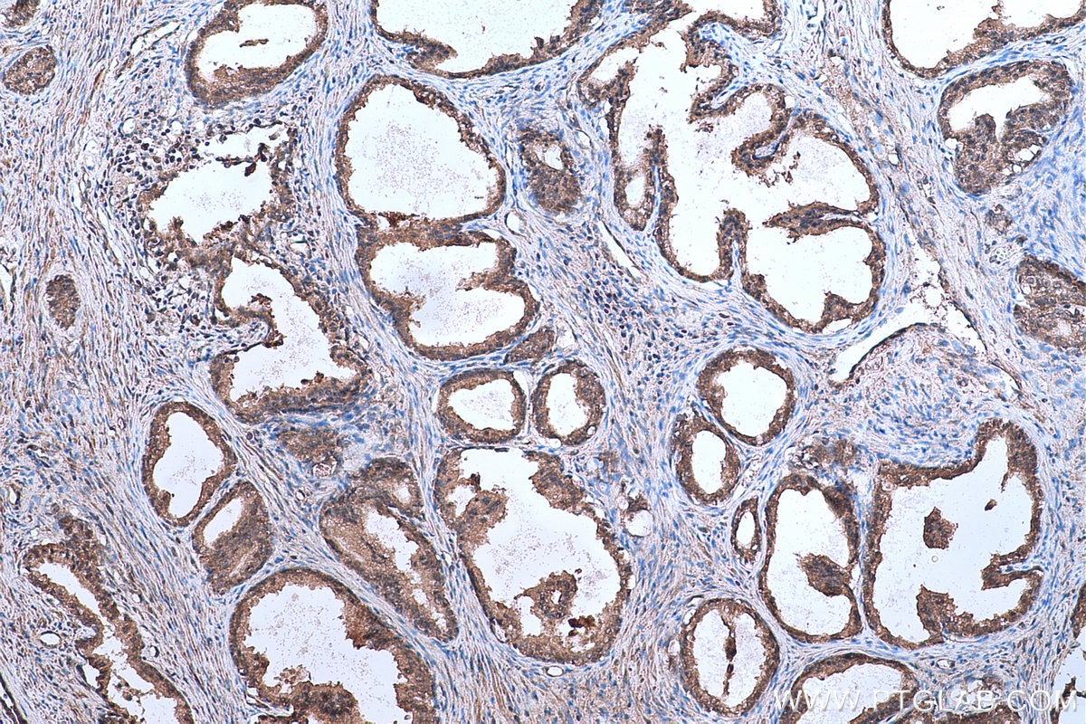 Immunohistochemical analysis of paraffin-embedded human prostate cancer tissue slide using KHC0650 (TMEFF2 IHC Kit).