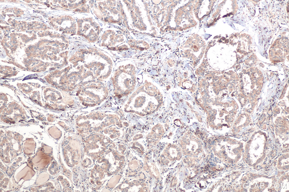 Immunohistochemical analysis of paraffin-embedded human thyroid cancer tissue slide using KHC0650 (TMEFF2 IHC Kit).