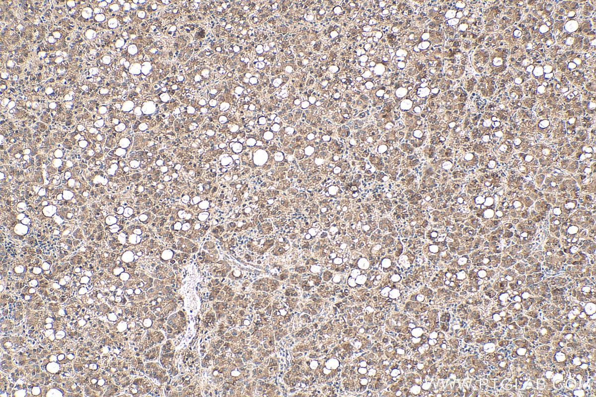 Immunohistochemical analysis of paraffin-embedded human liver cancer tissue slide using KHC0604 (TMEM16A/DOG1 IHC Kit).