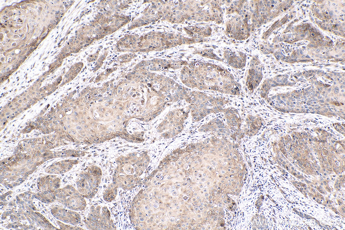 Immunohistochemical analysis of paraffin-embedded human oesophagus cancer tissue slide using KHC0604 (TMEM16A/DOG1 IHC Kit).