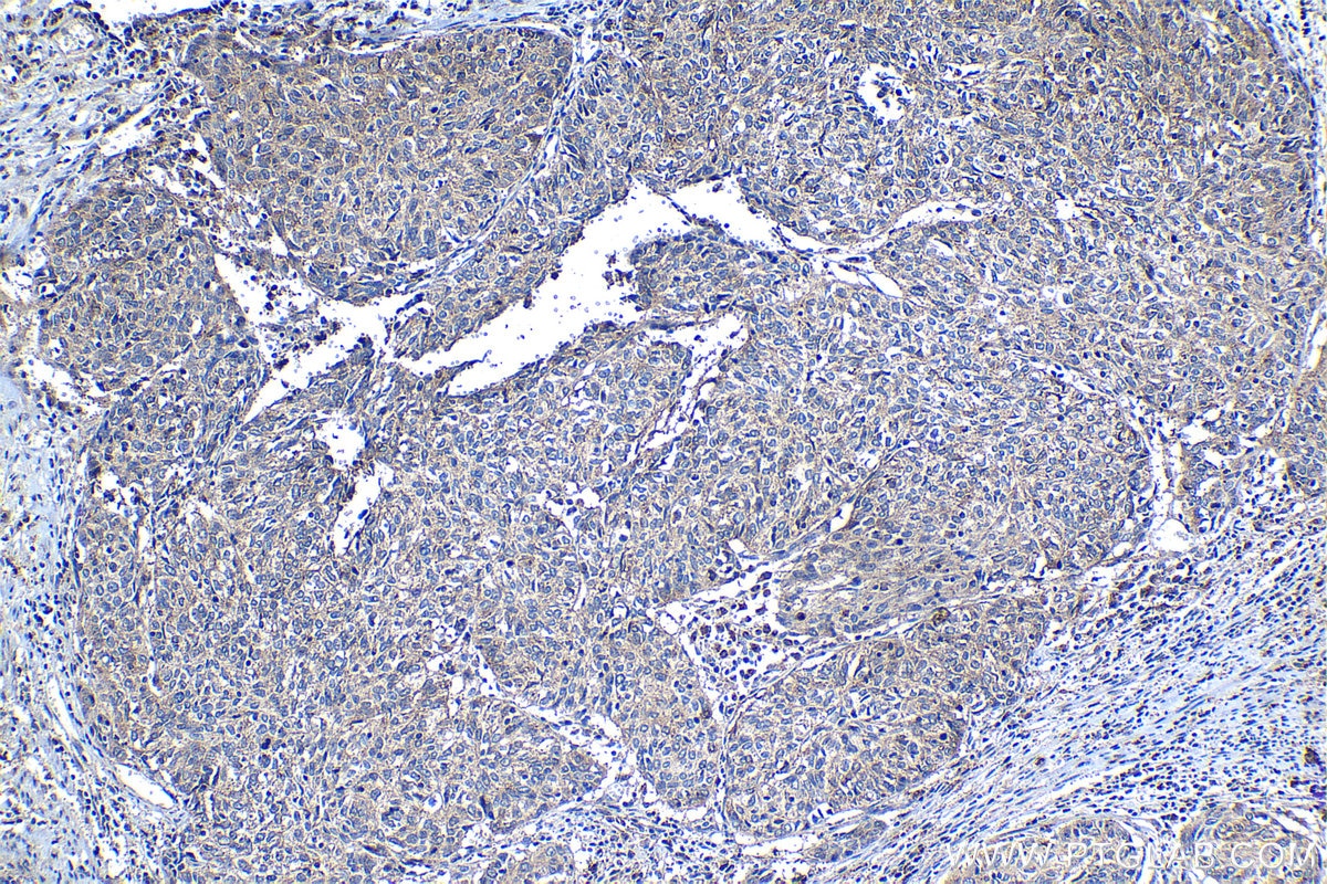 Immunohistochemical analysis of paraffin-embedded human cervical cancer tissue slide using KHC1252 (TMEM181 IHC Kit).