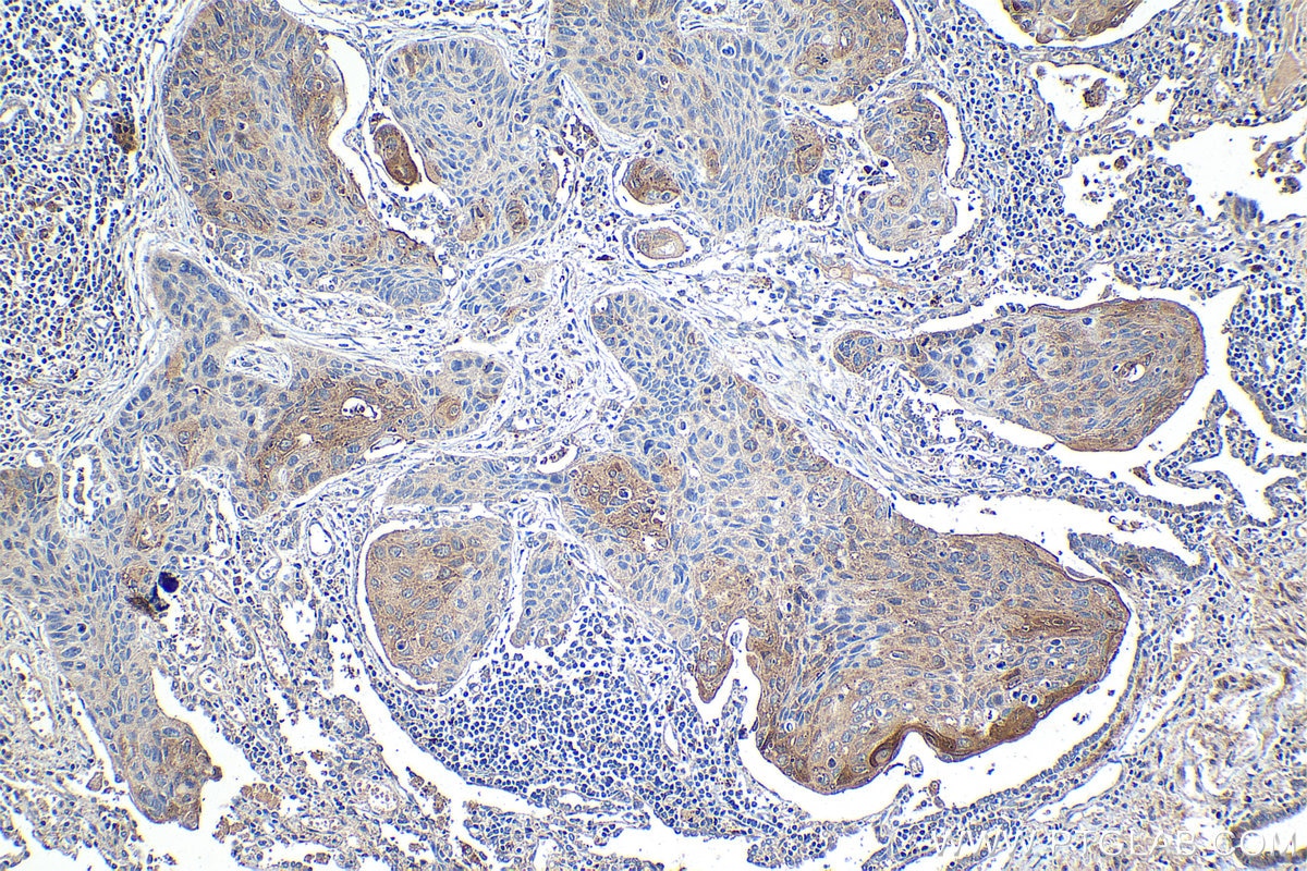 Immunohistochemical analysis of paraffin-embedded human lung cancer tissue slide using KHC1252 (TMEM181 IHC Kit).