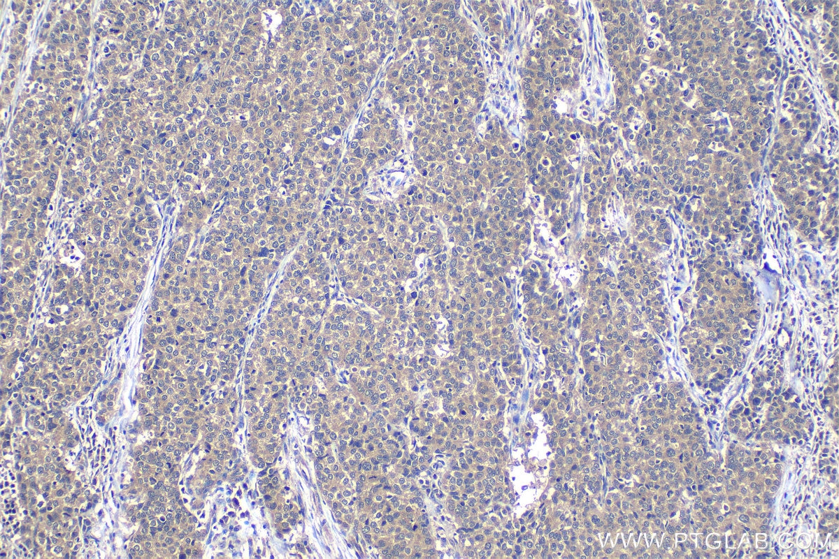 Immunohistochemical analysis of paraffin-embedded human stomach cancer tissue slide using KHC1198 (TMEM25 IHC Kit).