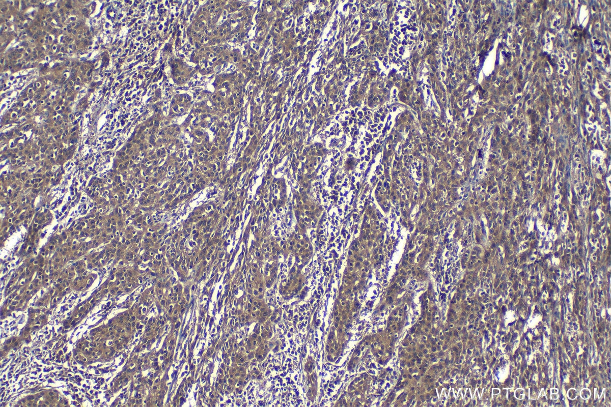 Immunohistochemical analysis of paraffin-embedded human cervical cancer tissue slide using KHC1198 (TMEM25 IHC Kit).