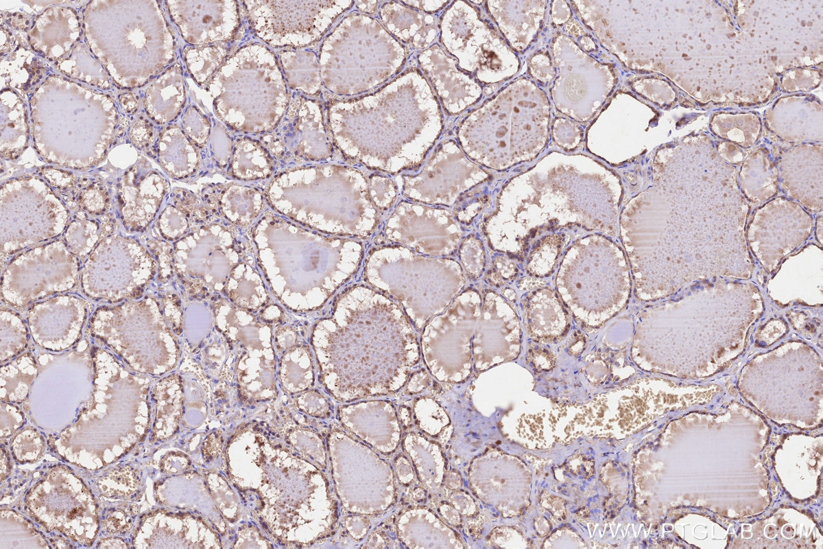 Immunohistochemical analysis of paraffin-embedded human thyroid cancer tissue slide using KHC3236 (TMEM258 IHC Kit).