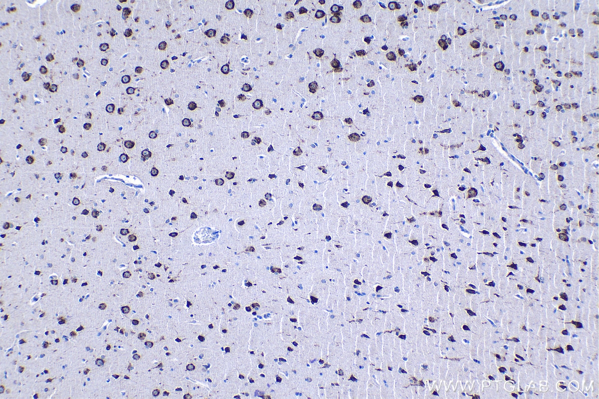 Immunohistochemical analysis of paraffin-embedded human gliomas tissue slide using KHC1289 (TMEM38A IHC Kit).