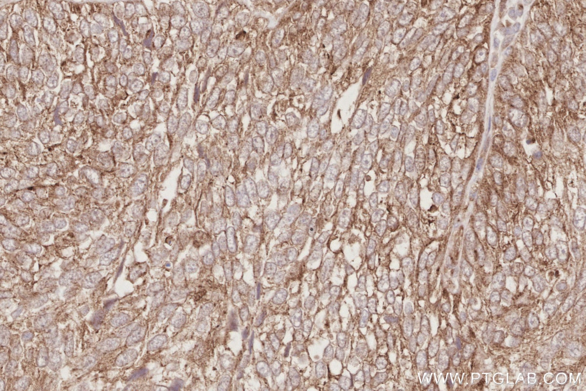 Immunohistochemical analysis of paraffin-embedded human ovary cancer tissue slide using KHC2882 (TMEM59 IHC Kit).
