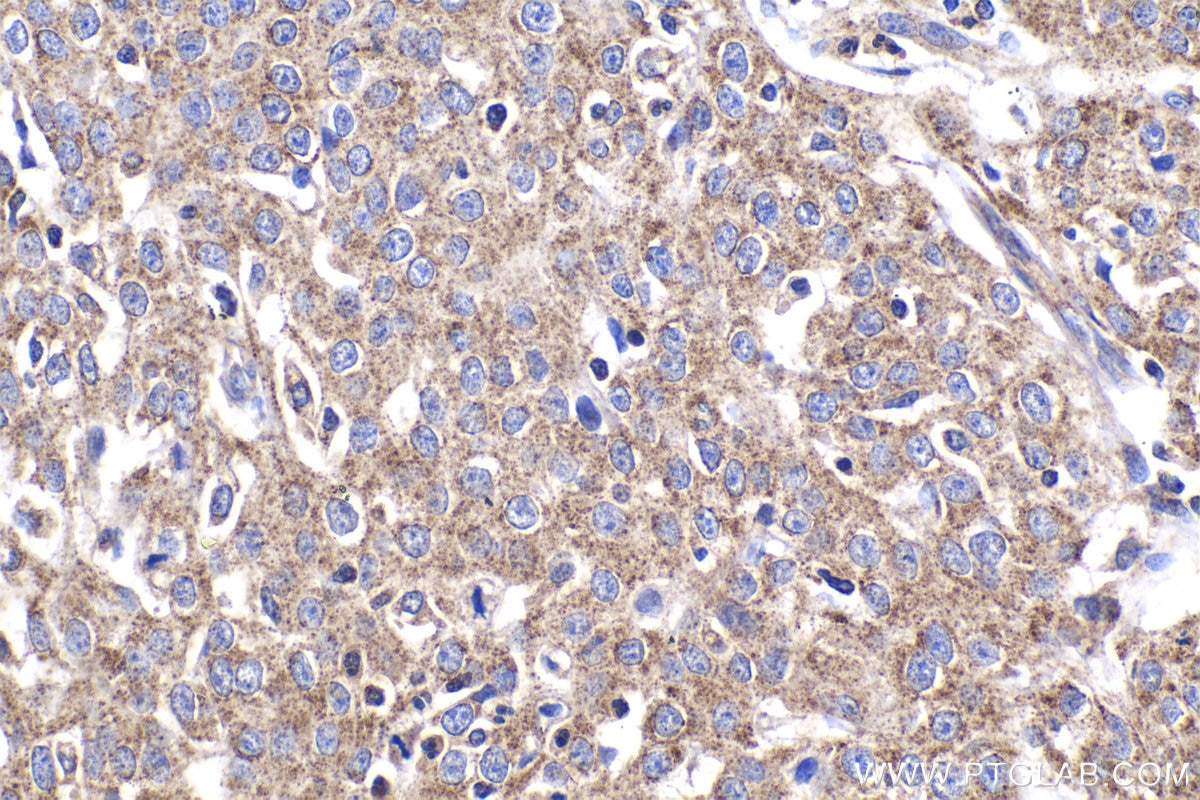 Immunohistochemical analysis of paraffin-embedded human cervical cancer tissue slide using KHC2039 (TMEM8B/NGX6 IHC Kit).
