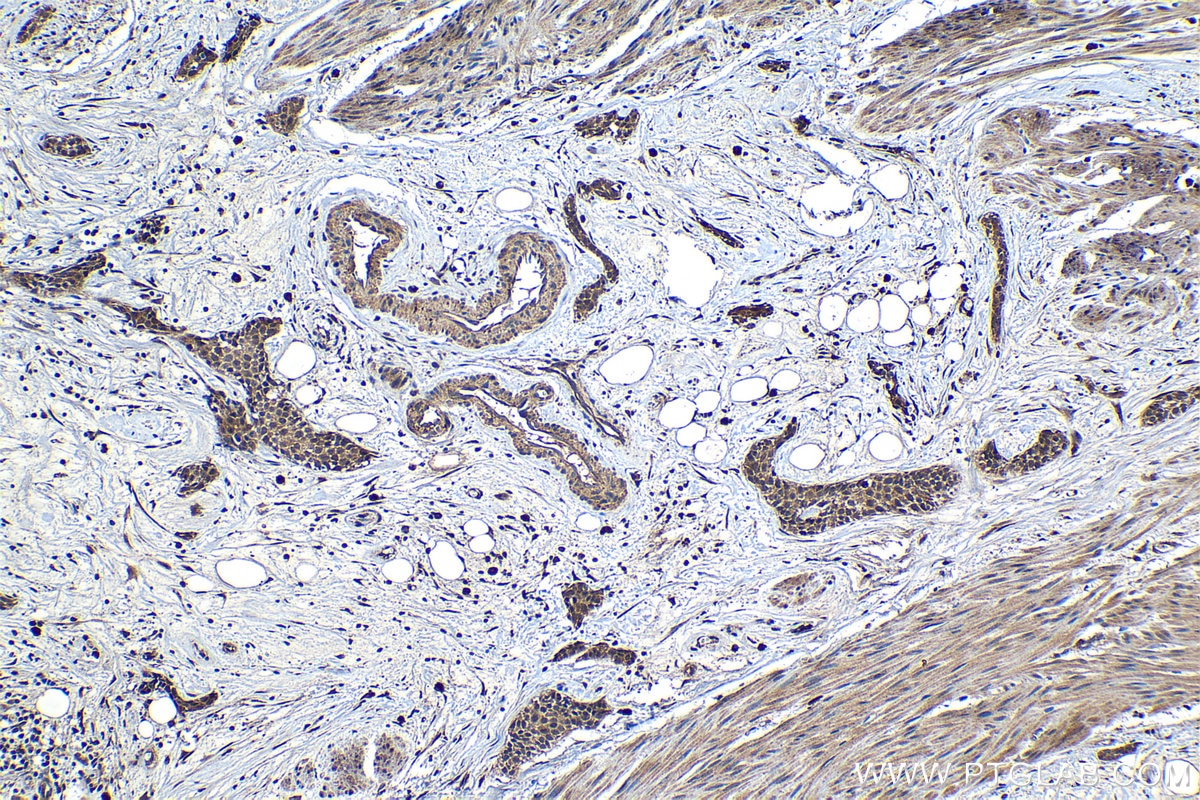 Immunohistochemical analysis of paraffin-embedded human urothelial carcinoma tissue slide using KHC1203 (TMEM97 IHC Kit).