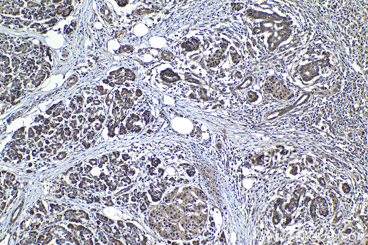 Immunohistochemical analysis of paraffin-embedded human pancreas cancer tissue slide using KHC1203 (TMEM97 IHC Kit).
