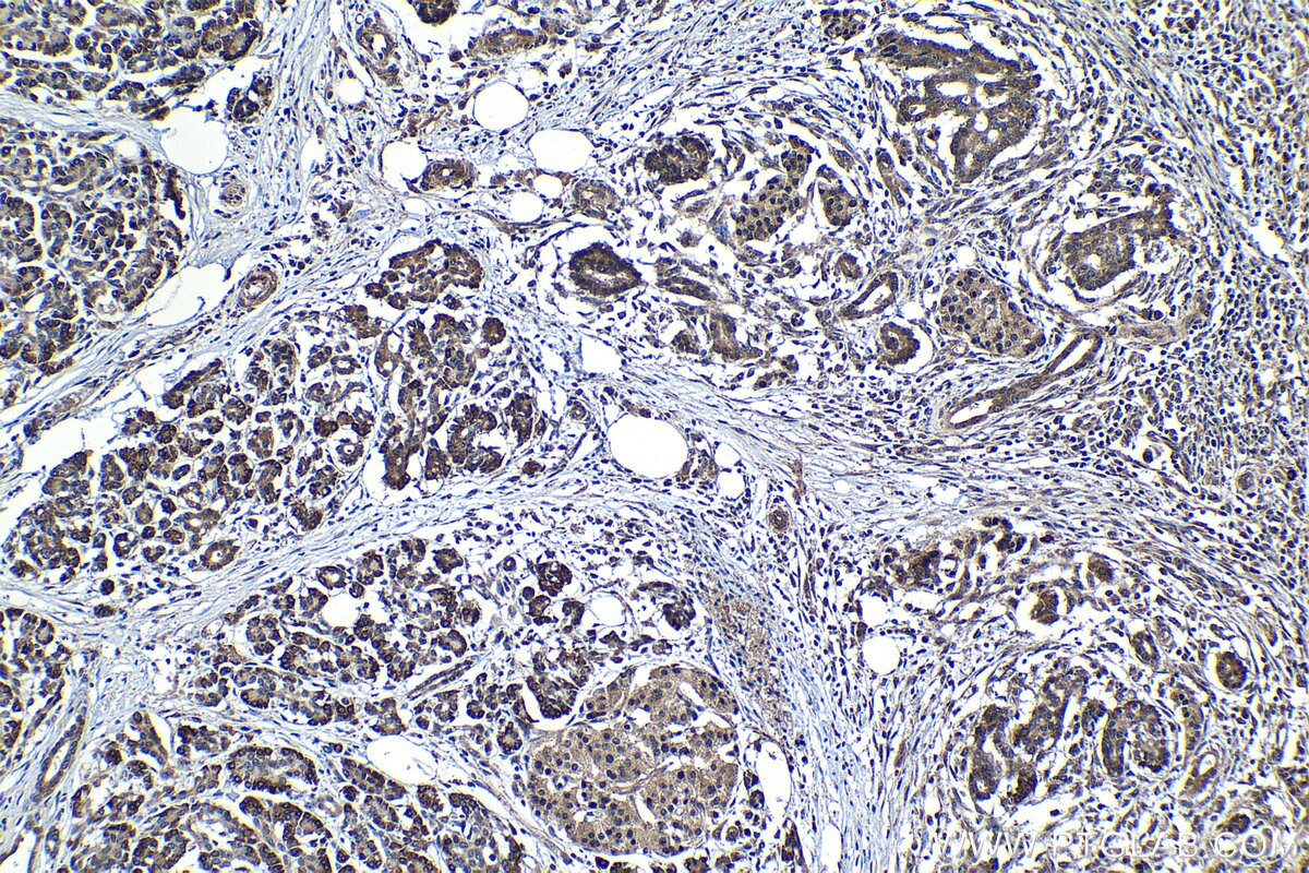 Immunohistochemical analysis of paraffin-embedded human pancreas cancer tissue slide using KHC1203 (TMEM97 IHC Kit).