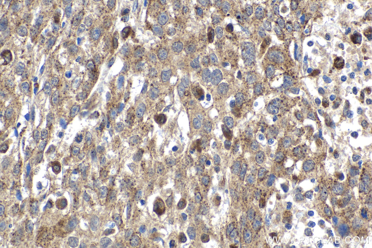 Immunohistochemical analysis of paraffin-embedded human cervical cancer tissue slide using KHC1655 (TMF1 IHC Kit).