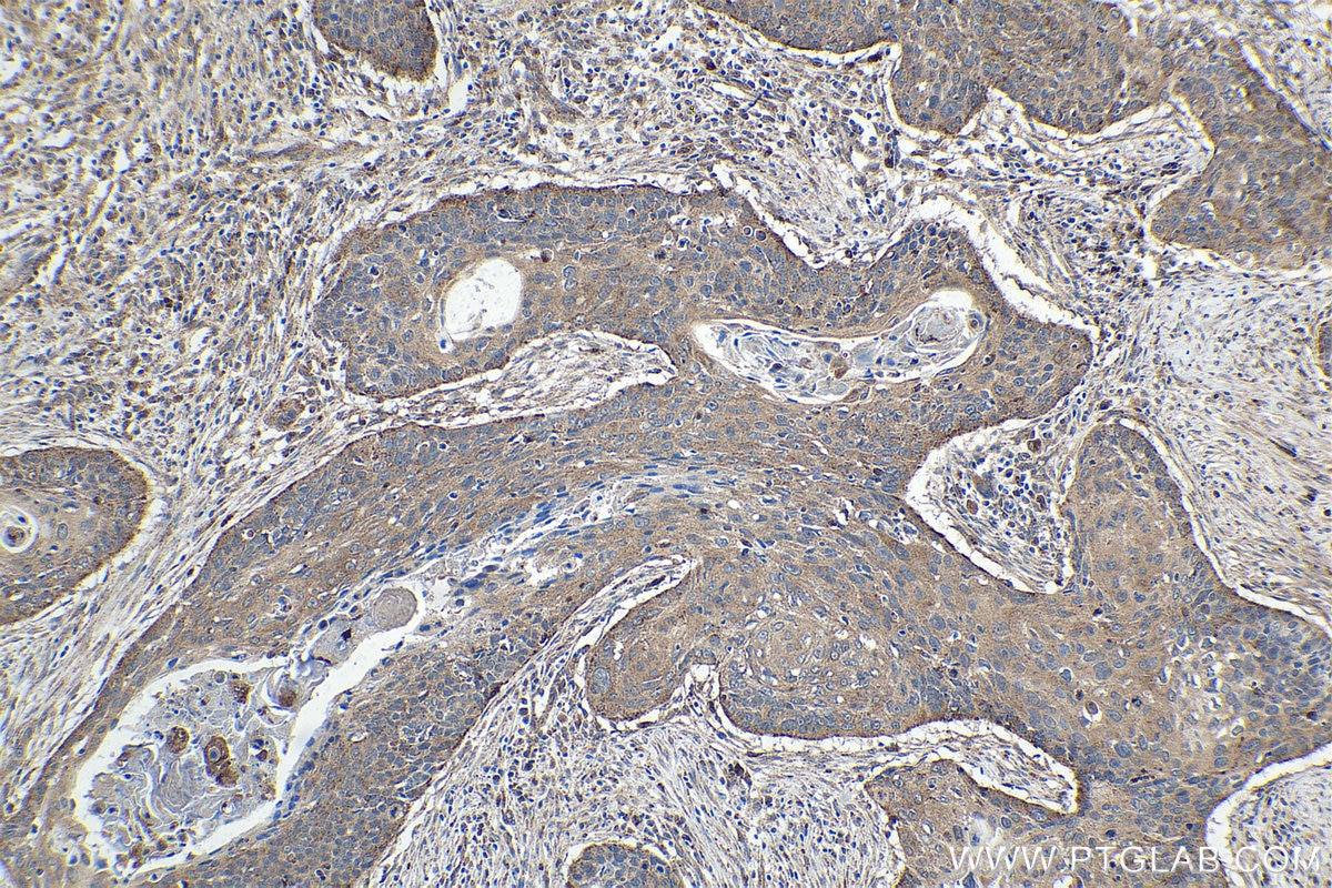 Immunohistochemical analysis of paraffin-embedded human oesophagus cancer tissue slide using KHC1655 (TMF1 IHC Kit).