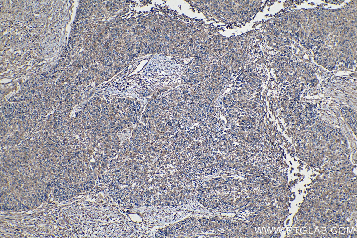 Immunohistochemical analysis of paraffin-embedded human lung cancer tissue slide using KHC1244 (TMOD3 IHC Kit).