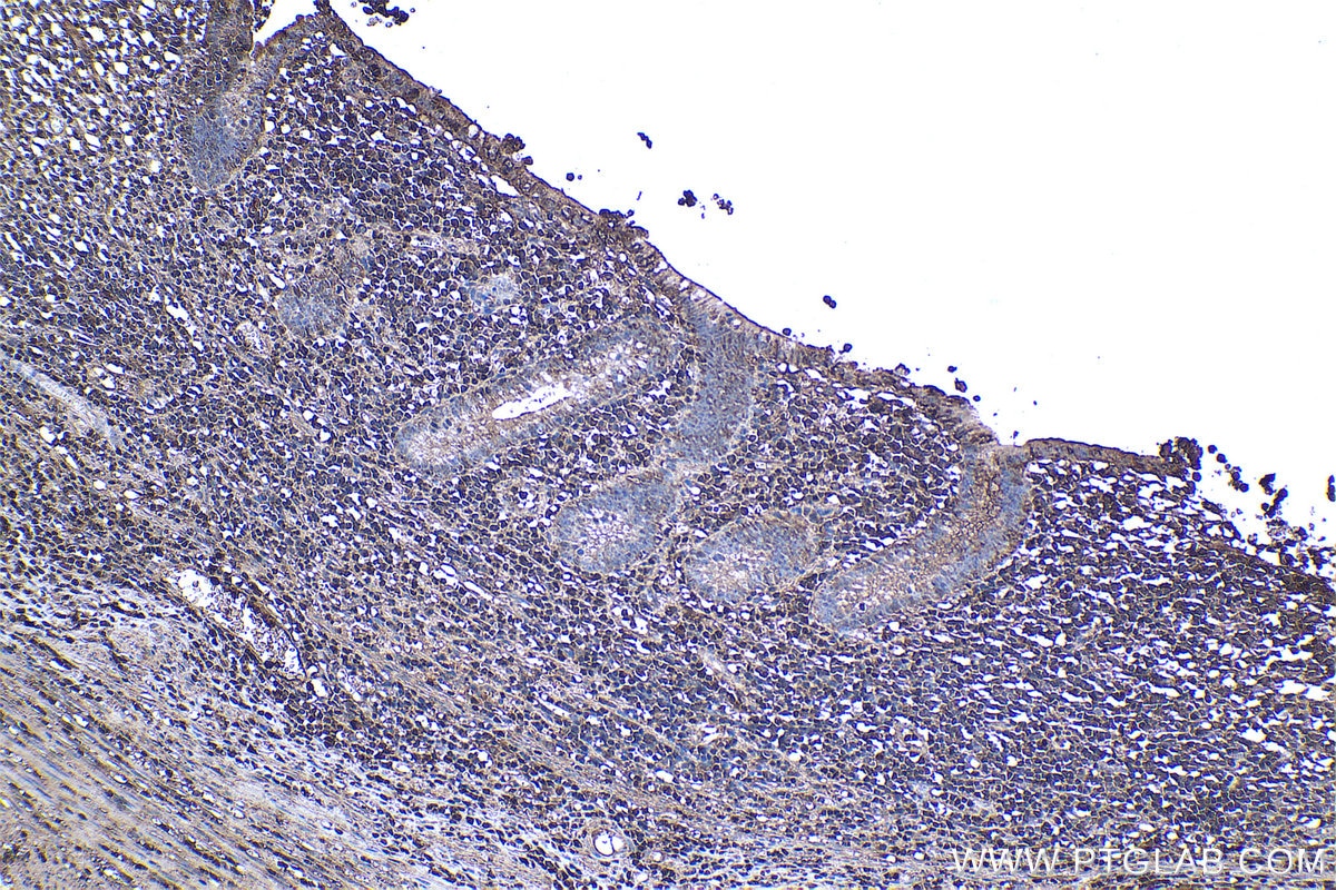 Immunohistochemical analysis of paraffin-embedded human appendicitis tissue slide using KHC1155 (TNF IHC Kit).