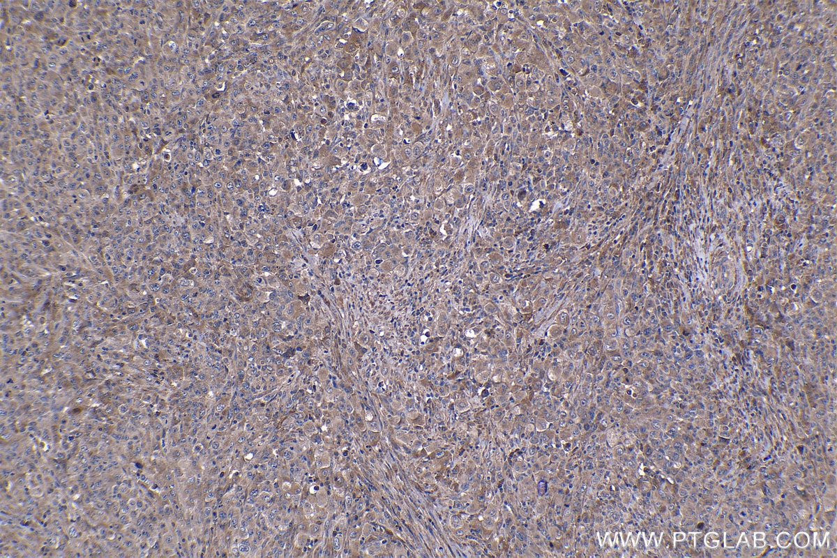 Immunohistochemical analysis of paraffin-embedded human lymphoma tissue slide using KHC1155 (TNF IHC Kit).