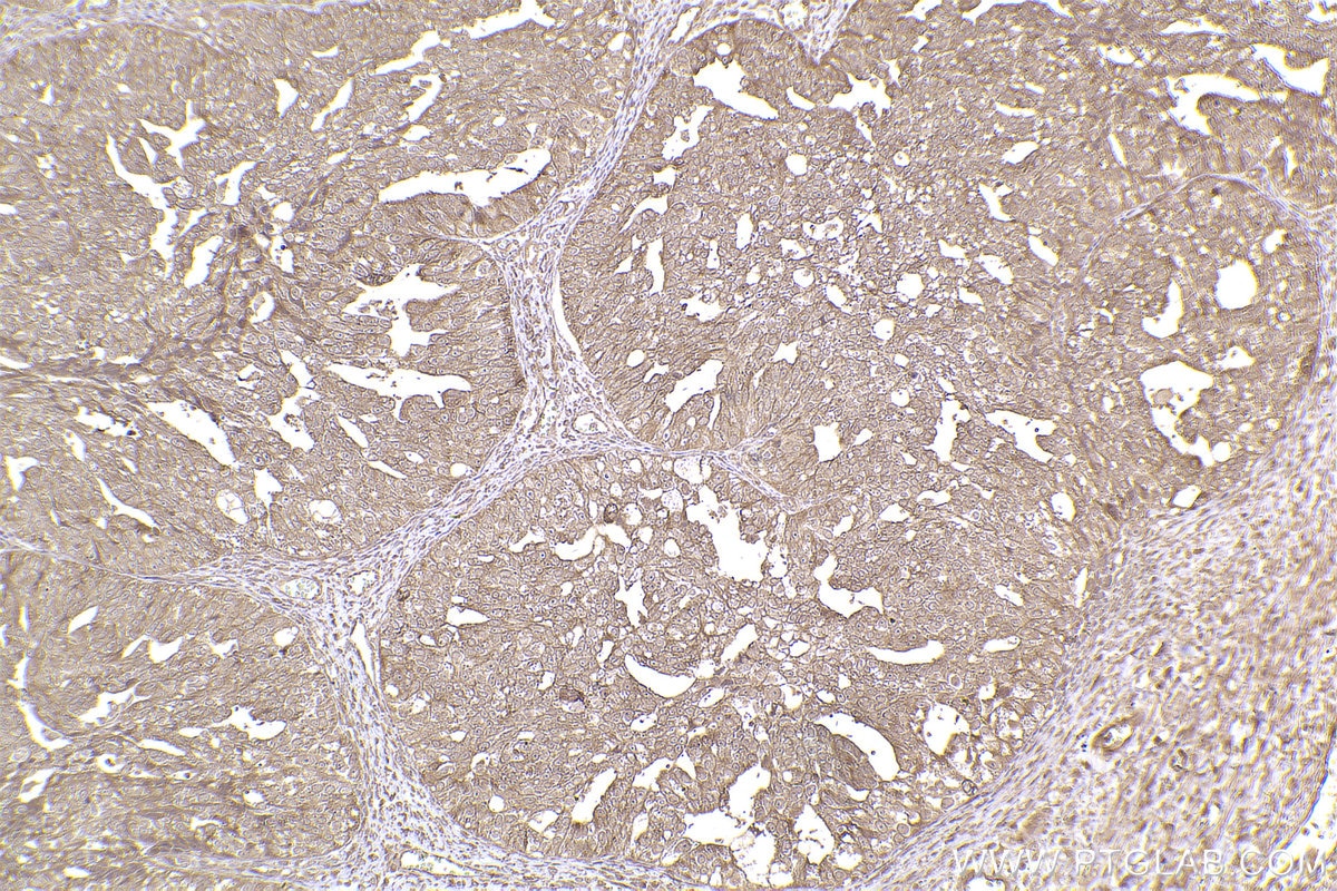 Immunohistochemical analysis of paraffin-embedded human ovary cancer tissue slide using KHC2443 (TNFAIP1 IHC Kit).