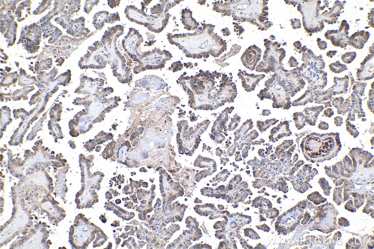 Immunohistochemical analysis of paraffin-embedded human thyroid cancer tissue slide using KHC1556 (TNFAIP3 IHC Kit).