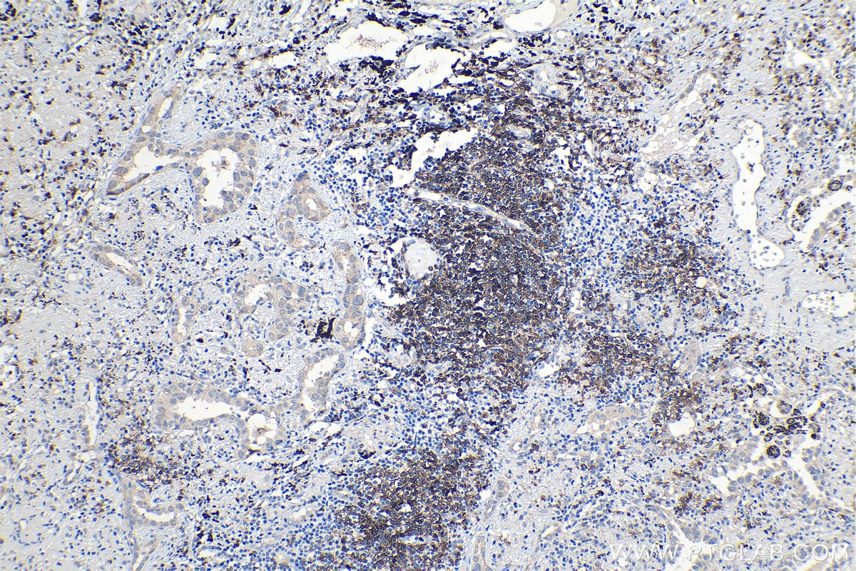 Immunohistochemical analysis of paraffin-embedded human lung cancer tissue slide using KHC1258 (TNFRSF13C IHC Kit).