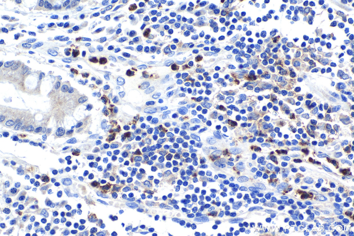Immunohistochemical analysis of paraffin-embedded human stomach cancer tissue slide using KHC1156 (TNFR2/TNFRSF1B IHC Kit).