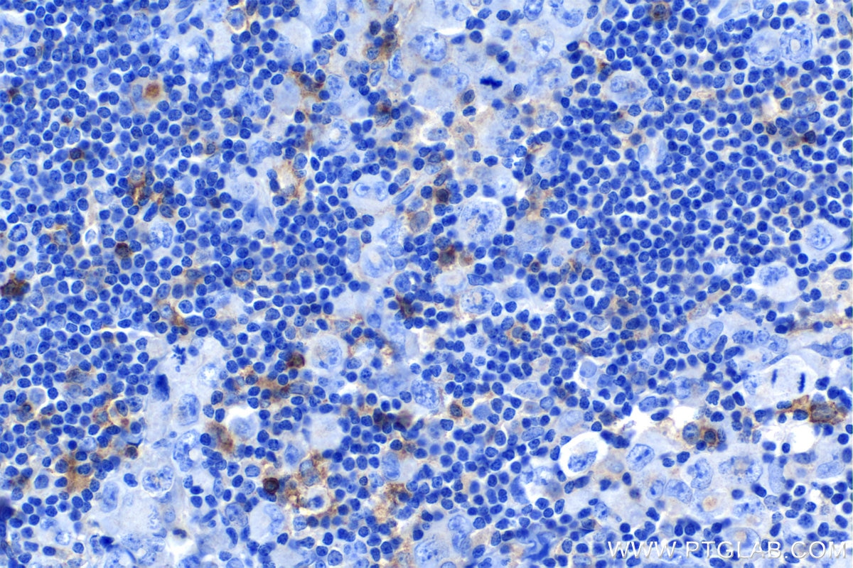Immunohistochemical analysis of paraffin-embedded human lymphoma tissue slide using KHC1156 (TNFR2/TNFRSF1B IHC Kit).