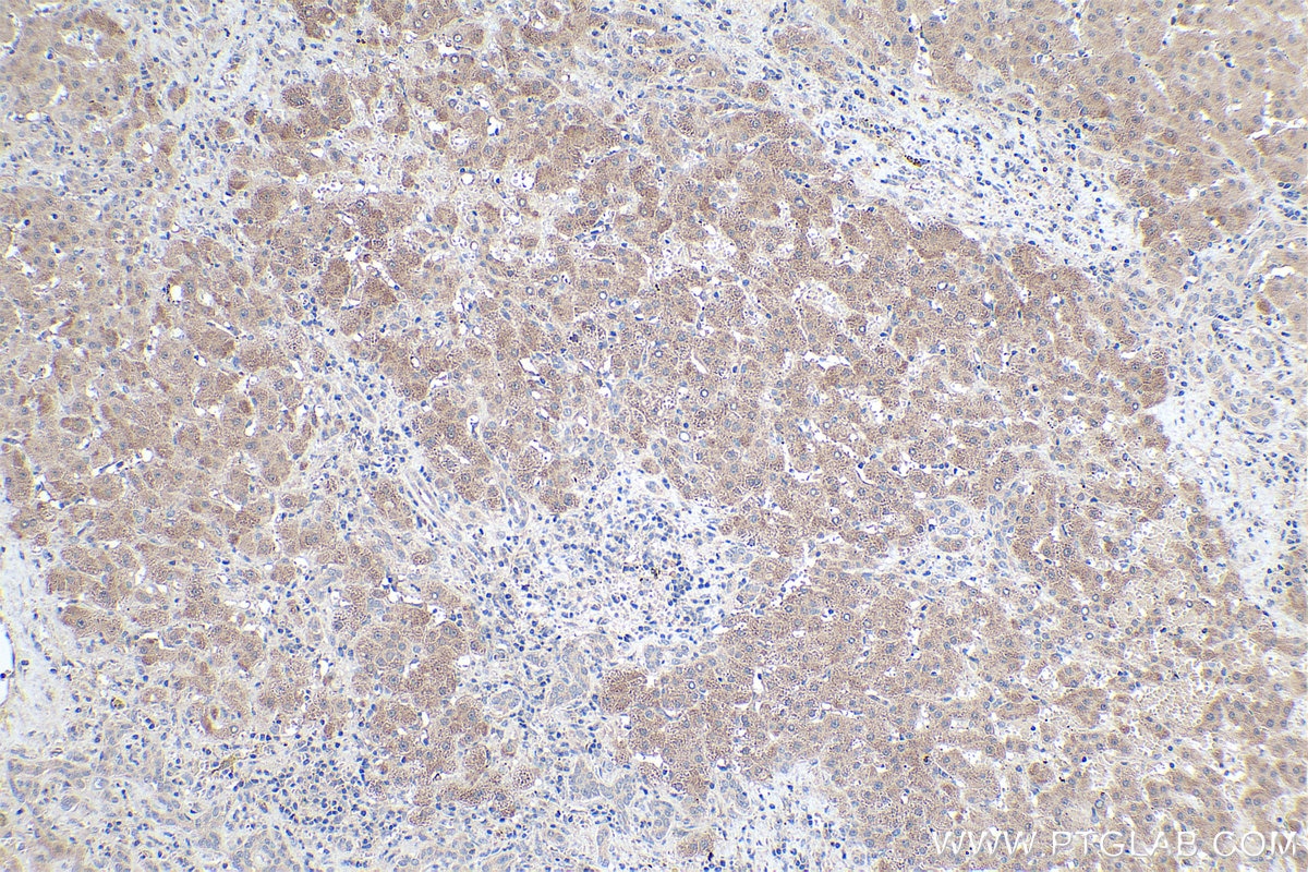 Immunohistochemical analysis of paraffin-embedded human liver cancer tissue slide using KHC0484 (TNFSF14/LIGHT IHC Kit).