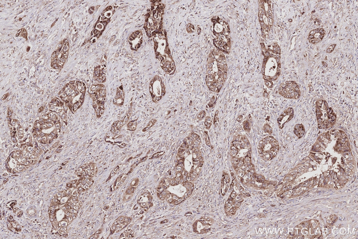 Immunohistochemical analysis of paraffin-embedded human pancreas cancer tissue slide using KHC3024 (TNIK IHC Kit).
