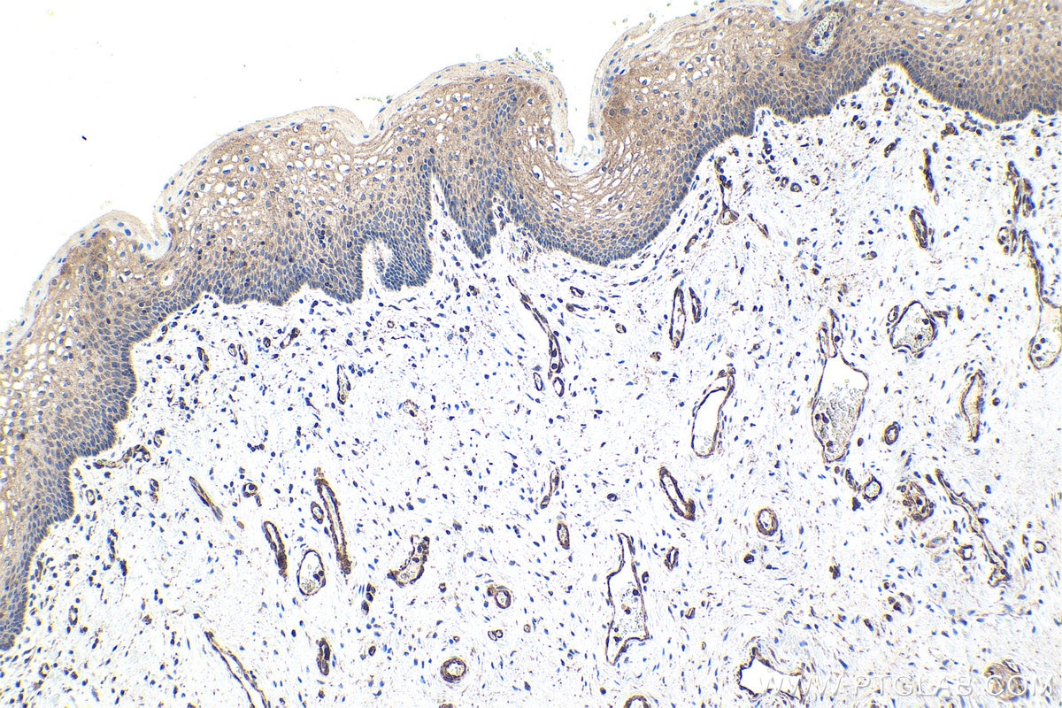 Immunohistochemical analysis of paraffin-embedded human cervical cancer tissue slide using KHC1747 (TNIP1 IHC Kit).