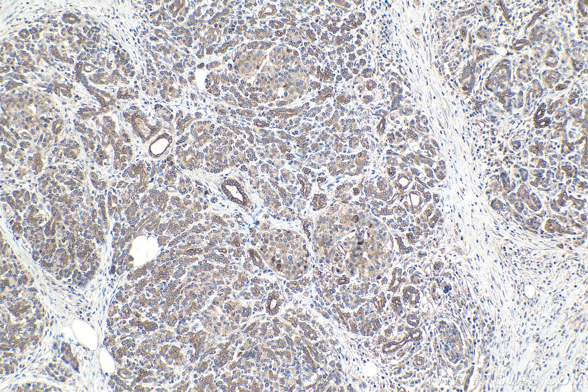 Immunohistochemical analysis of paraffin-embedded human pancreas cancer tissue slide using KHC1747 (TNIP1 IHC Kit).