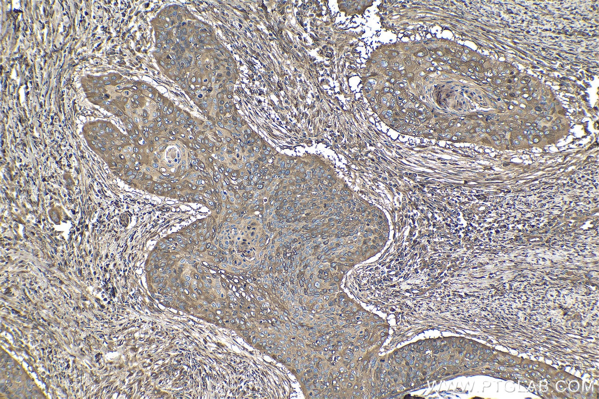 Immunohistochemical analysis of paraffin-embedded human oesophagus cancer tissue slide using KHC1840 (TNIP2 IHC Kit).