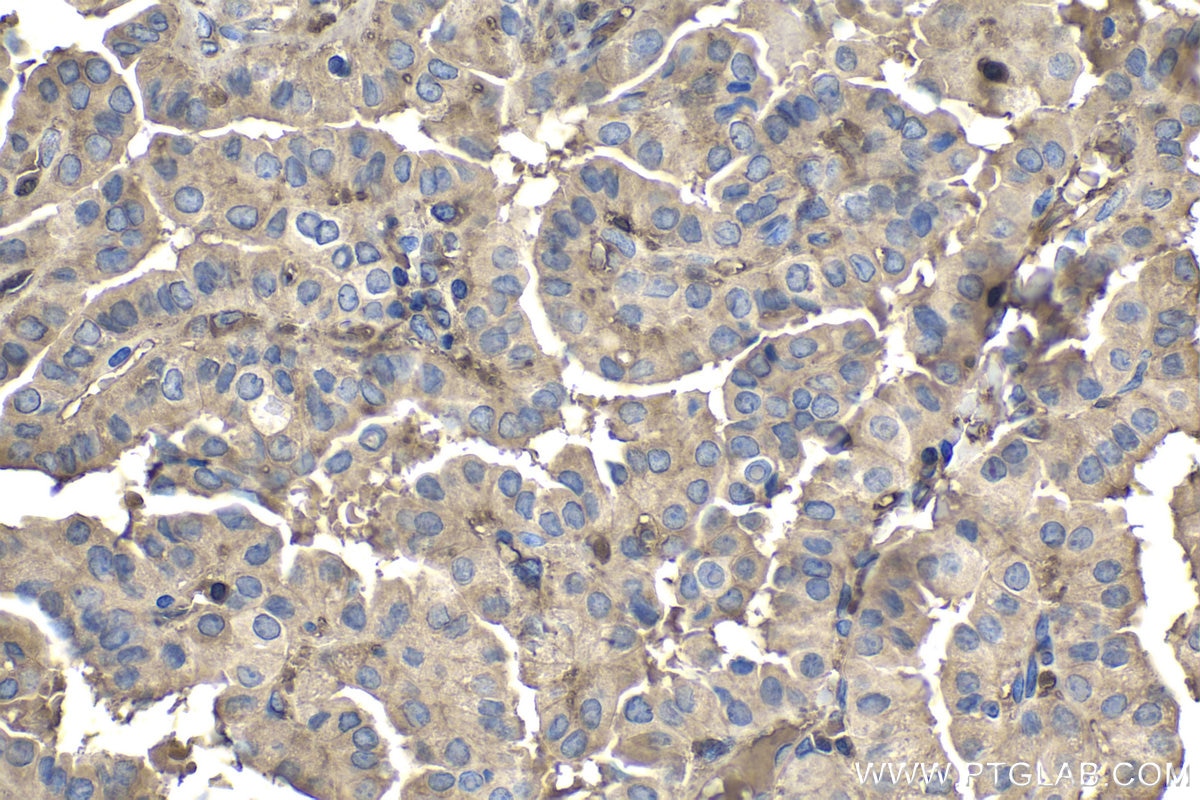 Immunohistochemical analysis of paraffin-embedded human thyroid cancer tissue slide using KHC1840 (TNIP2 IHC Kit).