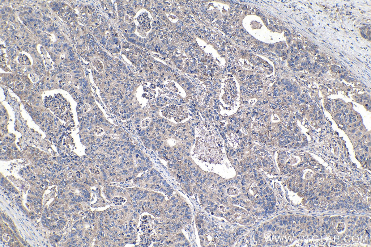 Immunohistochemical analysis of paraffin-embedded human stomach cancer tissue slide using KHC1492 (TNKS IHC Kit).