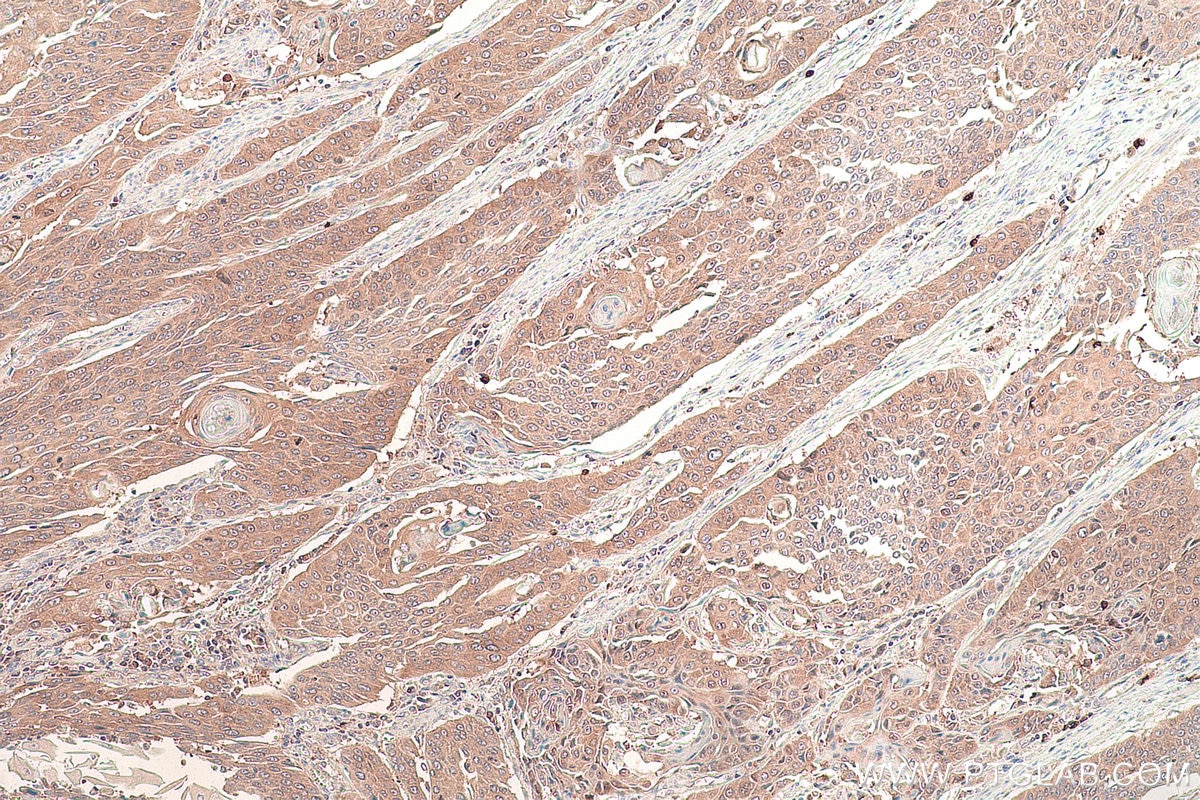 Immunohistochemical analysis of paraffin-embedded human oesophagus cancer tissue slide using KHC0857 (TOMM34 IHC Kit).